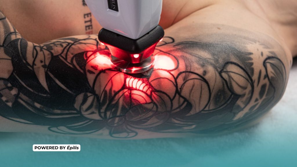 in foto il laser epilis in azione come epilazione progressiva permanente su peli bianchi e tatuaggi