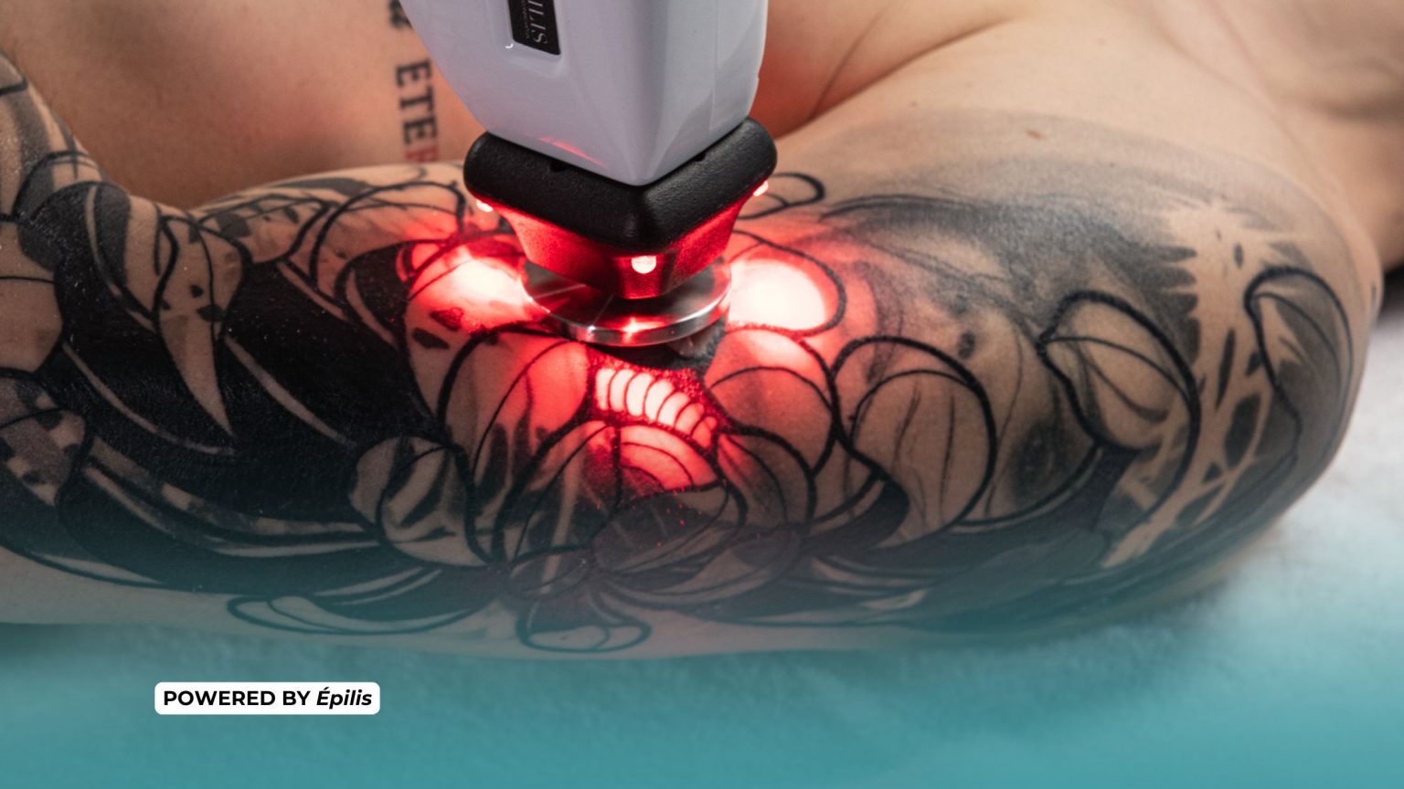 in foto il laser epilis in azione come epilazione progressiva permanente su peli bianchi e tatuaggi