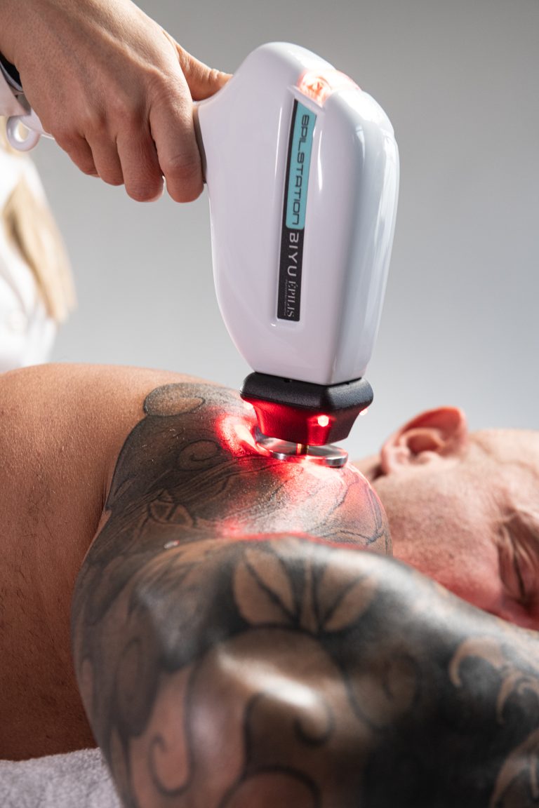in foto il laser epilis in azione come epilazione progressiva permanente su peli bianchi e tatuaggi