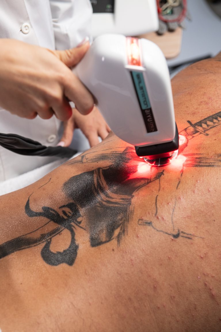 in foto il laser epilis in azione come epilazione progressiva permanente su peli bianchi e tatuaggi